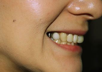 Teeth fillings